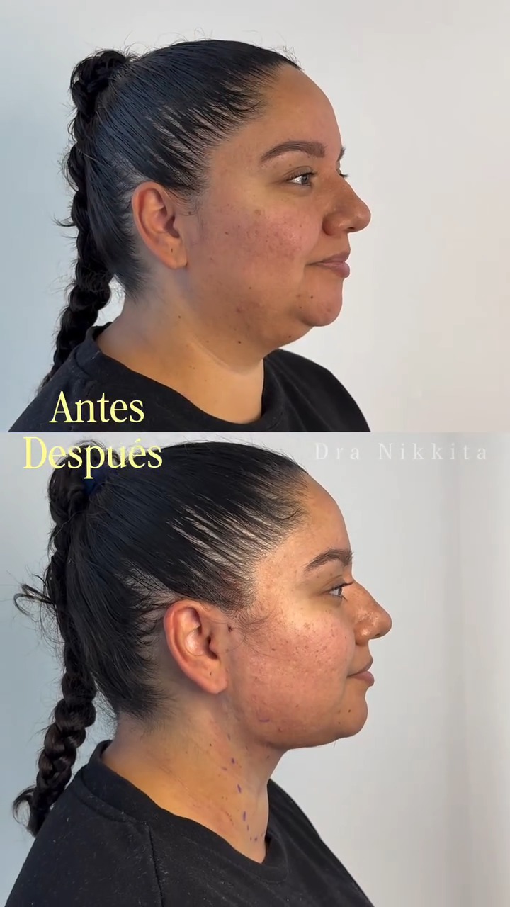 Fotograma del reel publicado por @dranikkita: una paciente de perfil, con trenza y polera negra, arriba rotulada «antes» y abajo «después» de la Lipopapada HD, con el contorno del cuello marcado.