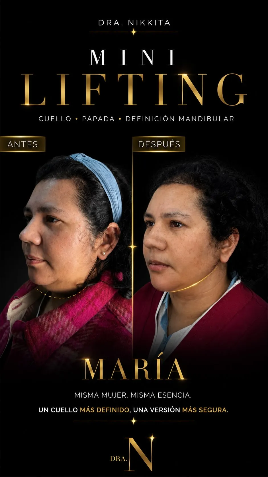 Tarjeta del caso de María: su perfil de antes y de después del Mini Lifting, marcados «antes» y «después».